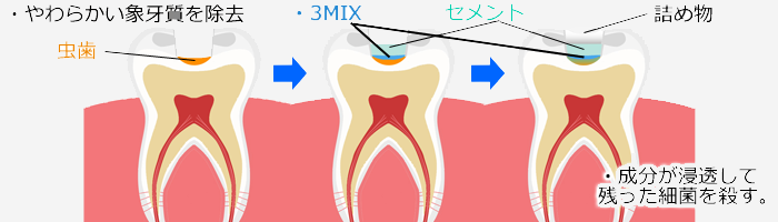 3MIX法　抗菌剤で治す虫歯治療