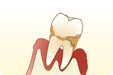 歯周病とは